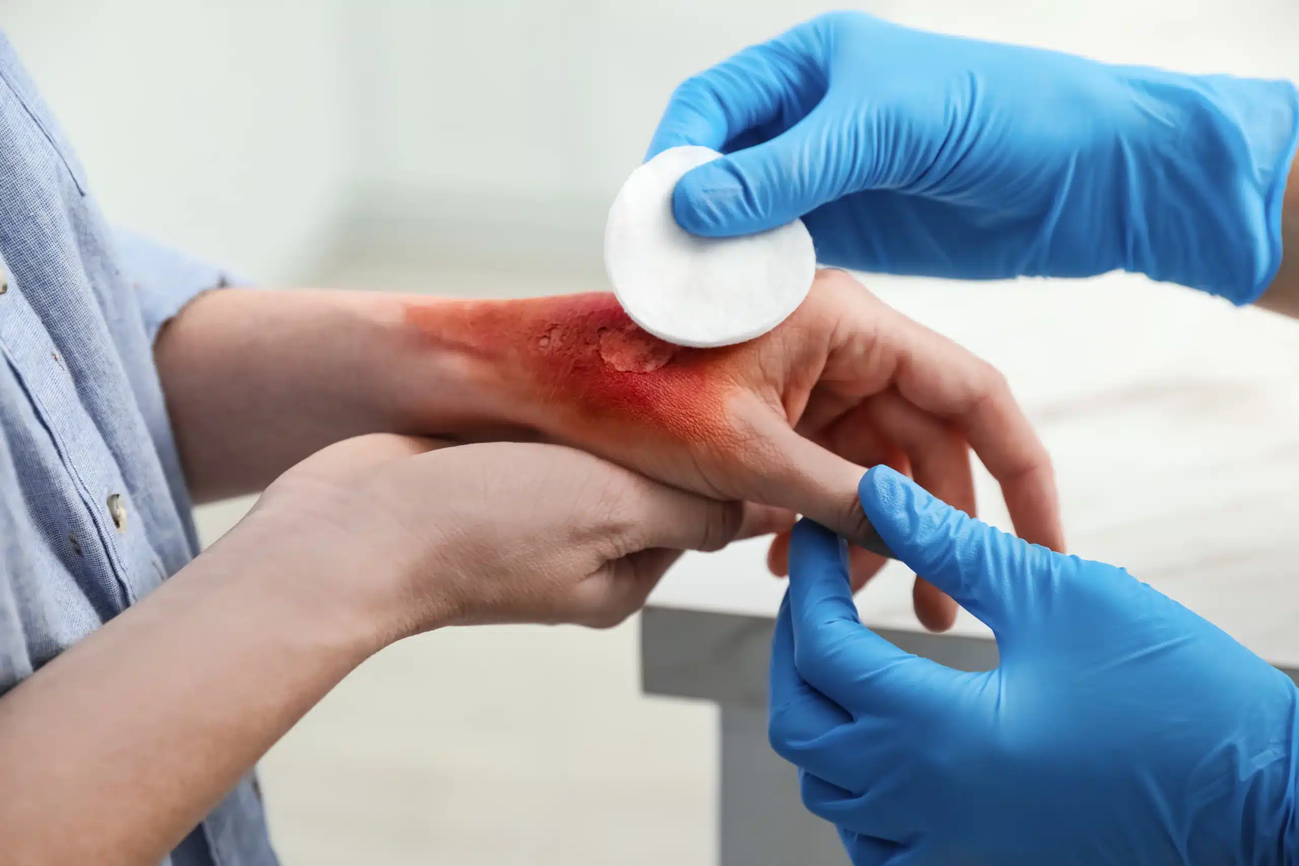 Healthcare worker treating a burn injury on a patient’s wrist